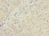 NUBPL Antibody - Immunohistochemistry of paraffin-embedded human liver cancer using antibody at dilution of 1:100.