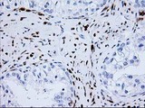 NUDEL / NDEL1 Antibody - IHC of paraffin-embedded Adenocarcinoma of Human ovary tissue using anti-NDEL1 mouse monoclonal antibody.