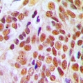 NUMA1 / NUMA Antibody - Immunohistochemical analysis of NUMA staining in human breast cancer formalin fixed paraffin embedded tissue section. The section was pre-treated using heat mediated antigen retrieval with sodium citrate buffer (pH 6.0). The section was then incubated with the antibody at room temperature and detected with HRP and DAB as chromogen. The section was then counterstained with hematoxylin and mounted with DPX.