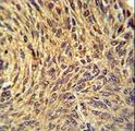 NUP210 / gp210 Antibody - NUP210 Antibody immunohistochemistry of formalin-fixed and paraffin-embedded human lung carcinoma followed by peroxidase-conjugated secondary antibody and DAB staining.