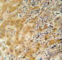 NUSAP1 / NUSAP Antibody - NUSAP antibody immunohistochemistry of formalin-fixed and paraffin-embedded human hepatocarcinoma followed by peroxidase-conjugated secondary antibody and DAB staining.