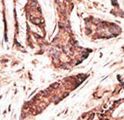 OASL Antibody - Formalin-fixed and paraffin-embedded human cancer tissue reacted with the primary antibody, which was peroxidase-conjugated to the secondary antibody, followed by AEC staining. This data demonstrates the use of this antibody for immunohistochemistry; clinical relevance has not been evaluated. BC = breast carcinoma; HC = hepatocarcinoma.