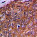 OAZ1 / OAZ Antibody - Immunohistochemical analysis of OAZ1 staining in human prostate cancer formalin fixed paraffin embedded tissue section. The section was pre-treated using heat mediated antigen retrieval with sodium citrate buffer (pH 6.0). The section was then incubated with the antibody at room temperature and detected using an HRP conjugated compact polymer system. DAB was used as the chromogen. The section was then counterstained with hematoxylin and mounted with DPX.