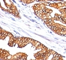 ODC1 / Ornithine Decarboxylase Antibody - Formalin-fixed, paraffin-embedded human prostate carcinoma stained with ODC-1 antibody (SPM565).  This image was taken for the unmodified form of this product. Other forms have not been tested.