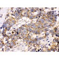 OPA1 Antibody - OPA1 antibody IHC-paraffin. IHC(P): Human Lung Cancer Tissue.
