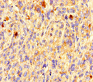 OR5L1 Antibody - Immunohistochemistry of paraffin-embedded human melanoma using OR5L1 Antibody at dilution of 1:100