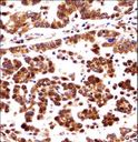 ORC3L / ORC3 Antibody - ORC3L Antibody immunohistochemistry of formalin-fixed and paraffin-embedded human lung adenocarcinoma followed by peroxidase-conjugated secondary antibody and DAB staining.