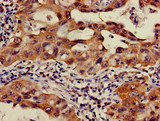 OS9 Antibody - Immunohistochemistry of paraffin-embedded human lung cancer using OS9 Antibody at dilution of 1:100
