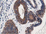 OSBP Antibody - IHC of paraffin-embedded Adenocarcinoma of Human endometrium tissue using anti-OSBP mouse monoclonal antibody. (Heat-induced epitope retrieval by 10mM citric buffer, pH6.0, 100C for 10min).