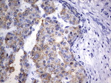 OTC Antibody - IHC of paraffin-embedded Carcinoma of Human liver tissue using anti-OTC mouse monoclonal antibody. (Heat-induced epitope retrieval by 1 mM EDTA in 10mM Tris, pH9.0, 120°C for 3min).
