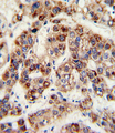 OTC Antibody - Formalin-fixed and paraffin-embedded human hepatocarcinoma with OTC Antibody , which was peroxidase-conjugated to the secondary antibody, followed by DAB staining. This data demonstrates the use of this antibody for immunohistochemistry; clinical relevance has not been evaluated.