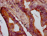 OTOP1 Antibody - Immunohistochemistry Dilution at 1:400 and staining in paraffin-embedded human colon cancer performed on a Leica BondTM system. After dewaxing and hydration, antigen retrieval was mediated by high pressure in a citrate buffer (pH 6.0). Section was blocked with 10% normal Goat serum 30min at RT. Then primary antibody (1% BSA) was incubated at 4°C overnight. The primary is detected by a biotinylated Secondary antibody and visualized using an HRP conjugated SP system.
