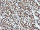 OTUB1 / OTU1 Antibody - IHC of paraffin-embedded Carcinoma of Human thyroid tissue using anti-OTUB1 mouse monoclonal antibody. (Heat-induced epitope retrieval by 10mM citric buffer, pH6.0, 100C for 10min).
