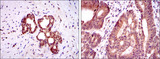 OTX2 Antibody - IHC of paraffin-embedded prostate tissues (left) and colon cancer tissues (right) using OTX2 mouse monoclonal antibody with DAB staining.
