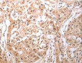 OX1R / Orexin Receptor 1 Antibody - Immunohistochemistry of paraffin-embedded Human lung cancer using HCRTR1 Polyclonal Antibody at dilution of 1:100.