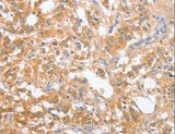 OX2R / Orexin Receptor 2 Antibody - Immunohistochemistry of paraffin-embedded Human thyroid cancer using CD200R1 Polyclonal Antibody at dilution of 1:60.