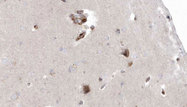OXCT1 Antibody - 1:100 staining human brain carcinoma tissue by IHC-P. The sample was formaldehyde fixed and a heat mediated antigen retrieval step in citrate buffer was performed. The sample was then blocked and incubated with the antibody for 1.5 hours at 22°C. An HRP conjugated goat anti-rabbit antibody was used as the secondary.