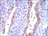 p16INK4a / CDKN2A Antibody - IHC of paraffin-embedded endometrial cancer tissues using CDKN2A mouse monoclonal antibody with DAB staining.