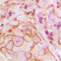 P2RY14 / GPR105 Antibody - Immunohistochemical analysis of GPR105 staining in human breast cancer formalin fixed paraffin embedded tissue section. The section was pre-treated using heat mediated antigen retrieval with sodium citrate buffer (pH 6.0). The section was then incubated with the antibody at room temperature and detected using an HRP conjugated compact polymer system. DAB was used as the chromogen. The section was then counterstained with hematoxylin and mounted with DPX.