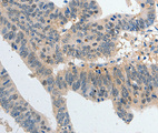 P2RY6 / P2Y6 Antibody - Immunohistochemistry of paraffin-embedded human colon cancer tissue, using P2RY6 antibody.