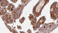 P2RY6 / P2Y6 Antibody - 1:100 staining human liver carcinoma tissues by IHC-P. The sample was formaldehyde fixed and a heat mediated antigen retrieval step in citrate buffer was performed. The sample was then blocked and incubated with the antibody for 1.5 hours at 22°C. An HRP conjugated goat anti-rabbit antibody was used as the secondary.