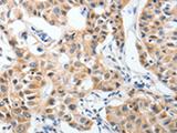 P2RY6 / P2Y6 Antibody - Immunohistochemistry of paraffin-embedded Human lung cancer tissue  using P2RY6 Polyclonal Antibody at dilution of 1:40(×200)