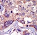 p56lck / LCK Antibody - Formalin-fixed and paraffin-embedded human cancer tissue reacted with the primary antibody, which was peroxidase-conjugated to the secondary antibody, followed by AEC staining. This data demonstrates the use of this antibody for immunohistochemistry; clinical relevance has not been evaluated. BC = breast carcinoma; HC = hepatocarcinoma.