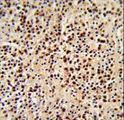 p56lck / LCK Antibody - Formalin-fixed and paraffin-embedded human lymphoma reacted with LCK Antibody , which was peroxidase-conjugated to the secondary antibody, followed by DAB staining. This data demonstrates the use of this antibody for immunohistochemistry; clinical relevance has not been evaluated.