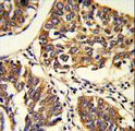 PABPC1 / PABP1 Antibody - Formalin-fixed and paraffin-embedded human lung carcinoma reacted with PABPC1 Antibody , which was peroxidase-conjugated to the secondary antibody, followed by DAB staining. This data demonstrates the use of this antibody for immunohistochemistry; clinical relevance has not been evaluated.