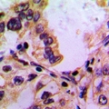 PABPC5 Antibody - Immunohistochemical analysis of PABPC5 staining in human lung cancer formalin fixed paraffin embedded tissue section. The section was pre-treated using heat mediated antigen retrieval with sodium citrate buffer (pH 6.0). The section was then incubated with the antibody at room temperature and detected with HRP and DAB as chromogen. The section was then counterstained with hematoxylin and mounted with DPX.