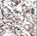 PAEL Receptor / GPR37 Antibody - Formalin-fixed and paraffin-embedded human cancer tissue reacted with the primary antibody, which was peroxidase-conjugated to the secondary antibody, followed by DAB staining. This data demonstrates the use of this antibody for immunohistochemistry; clinical relevance has not been evaluated. BC = breast carcinoma; HC = hepatocarcinoma.