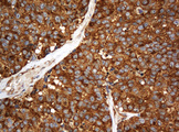 PAI-RBP1 / SERBP1 Antibody - IHC of paraffin-embedded Carcinoma of Human lung tissue using anti-SERBP1 mouse monoclonal antibody. (Heat-induced epitope retrieval by 10mM citric buffer, pH6.0, 120°C for 3min).