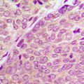PAK1 + PAK2 + PAK3 Antibody - Immunohistochemical analysis of PAK1/2/3 (pS144/141/139) staining in human breast cancer formalin fixed paraffin embedded tissue section. The section was pre-treated using heat mediated antigen retrieval with sodium citrate buffer (pH 6.0). The section was then incubated with the antibody at room temperature and detected using an HRP conjugated compact polymer system. DAB was used as the chromogen. The section was then counterstained with hematoxylin and mounted with DPX.