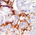 PAK3 Antibody - Formalin-fixed and paraffin-embedded human cancer tissue reacted with the primary antibody, which was peroxidase-conjugated to the secondary antibody, followed by AEC staining. This data demonstrates the use of this antibody for immunohistochemistry; clinical relevance has not been evaluated. BC = breast carcinoma; HC = hepatocarcinoma.