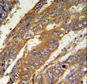 PAN3 Antibody - PAN3 Antibody IHC of formalin-fixed and paraffin-embedded human cervix carcinoma followed by peroxidase-conjugated secondary antibody and DAB staining.