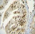 PAPOLA Antibody - PAP Antibody immunohistochemistry of formalin-fixed and paraffin-embedded human prostate carcinoma followed by peroxidase-conjugated secondary antibody and DAB staining.