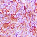 PAQR7 / mSR Antibody - Immunohistochemical analysis of mPR alpha staining in human breast cancer formalin fixed paraffin embedded tissue section. The section was pre-treated using heat mediated antigen retrieval with sodium citrate buffer (pH 6.0). The section was then incubated with the antibody at room temperature and detected using an HRP polymer system. DAB was used as the chromogen. The section was then counterstained with hematoxylin and mounted with DPX.