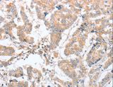 PARD6A / PAR6 Antibody - Immunohistochemistry of paraffin-embedded Human breast cancer using PARD6A Polyclonal Antibody at dilution of 1:60.