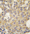 PARG Antibody - Formalin-fixed and paraffin-embedded human breast carcinoma tissue reacted with Parg antibody , which was peroxidase-conjugated to the secondary antibody, followed by DAB staining. This data demonstrates the use of this antibody for immunohistochemistry; clinical relevance has not been evaluated.