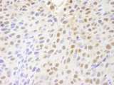 PARP10 Antibody - Detection of Mouse PARP10 by Immunohistochemistry. Sample: FFPE section of mouse squamous cell carcinoma. Antibody: Affinity purified rabbit anti-PARP10 used at a dilution of 1:250.