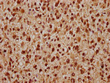 PARP7 / TIPARP Antibody - Immunohistochemistry Dilution at 1:300 and staining in paraffin-embedded human glioma cancer performed on a Leica BondTM system. After dewaxing and hydration, antigen retrieval was mediated by high pressure in a citrate buffer (pH 6.0). Section was blocked with 10% normal Goat serum 30min at RT. Then primary antibody (1% BSA) was incubated at 4°C overnight. The primary is detected by a biotinylated Secondary antibody and visualized using an HRP conjugated SP system.