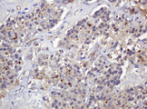 PARVB Antibody - IHC of paraffin-embedded Carcinoma of Human pancreas tissue using anti-PARVB mouse monoclonal antibody.