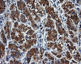 PAS Kinase / PASK Antibody - IHC of paraffin-embedded Carcinoma of liver tissue using anti-PASK mouse monoclonal antibody. (Dilution 1:50).