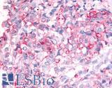 ADAMTS5 Antibody - Breast, carcinoma
