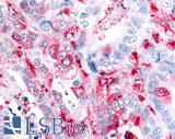 ADAMTS5 Antibody - Colon, Carcinoma