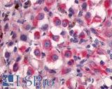 ADGRG2 / GPR64 Antibody - Skin, Malignant Melanoma