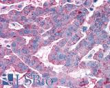 ADGRG3 / GPR97 Antibody - Ovary, carcinoma