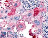 ADGRL4 / ELTD1 Antibody - Lung, Non Small-Cell Carcinoma