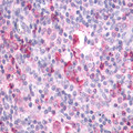 APLNR/ Apelin Receptor / APJ Antibody - lymph node, Hodgkin's lymphoma