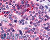 CALCR / Calcitonin Receptor Antibody - Anti-CALCR / Calcitonin Receptor antibody IHC of human Thyroid, Medullary Carcinoma. Immunohistochemistry of formalin-fixed, paraffin-embedded tissue after heat-induced antigen retrieval.